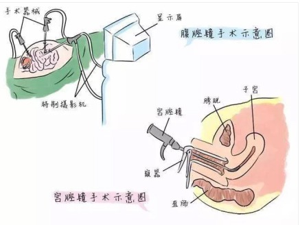 宫腹腔镜联合是 不孕不育诊断的金标准,能同时对输卵管,子宫